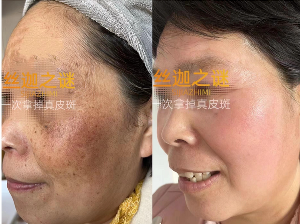 Spotless Bright · Ageless Glow 90-mins Facial